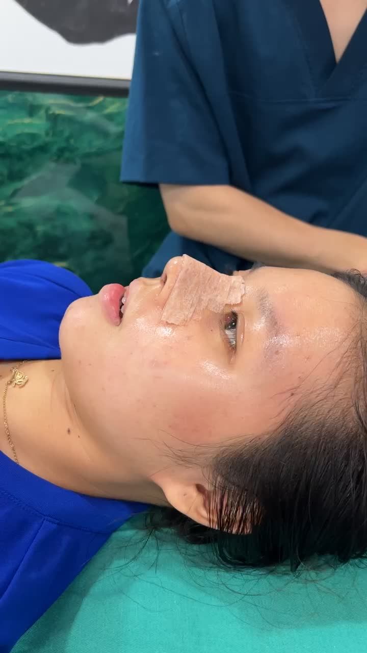 Thay nẹp sau 5 ngày nâng mũi cấu trúc Surgiform dáng mũi sẽ như thế nào